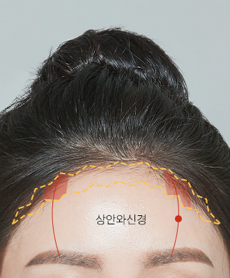 이마거상+축소술 STEP 1 이미지