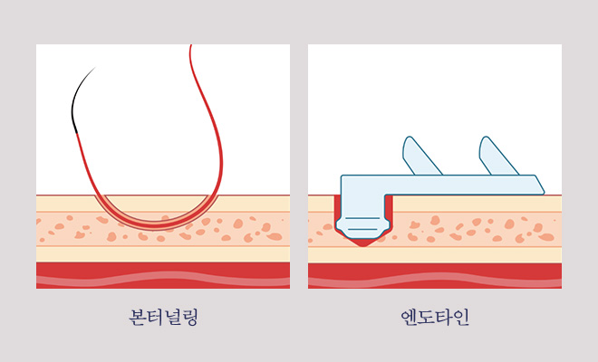 피부 두께와 피부 특성에 맞춘 고정 방법