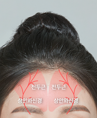 이마축소 STEP 2 이미지